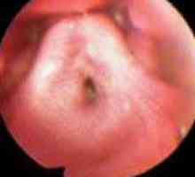 Stenoza acută a laringelui