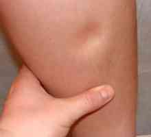 Umflarea picioarelor in timpul sarcinii