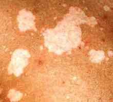 Chromophytosis: simptome și tratament, fotografie lipsindu