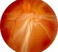 Disinsertion retiniene