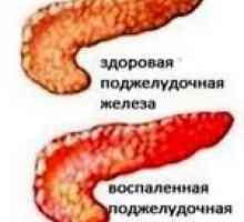 Pancreatită cronică