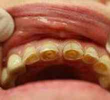 Abraziune dentara patologica