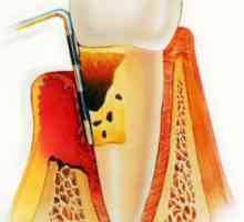 Parodontitei: Simptome si tratament