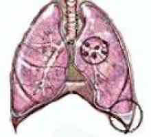 Cancer pulmonar cu celule scuamoase