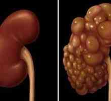 Boli de rinichi multichistică