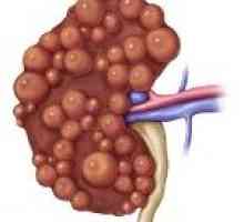 Boli de rinichi multichistică