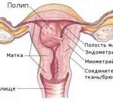 Polipi endometriali. polip endometrial