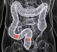 Simptomele cancerului de colon la un stadiu incipient