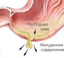 Ulcer perforat