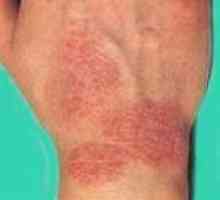 Eczema la locul de muncă