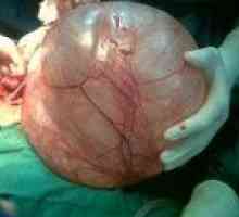 Ovar cystoma Pseudomucinous