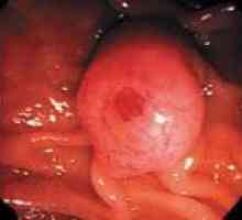 Cancerul de papilă duodenală majore