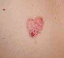 Cancer de piele: simptome, tratament