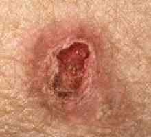 Cancer de piele