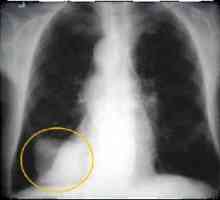 Cancerul pulmonar: simptome, semne, tratament