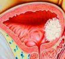 Cancerul de vezică urinară