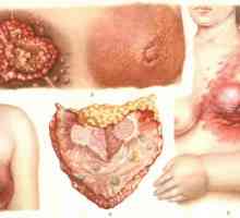 Cancerul mamar