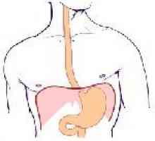 Carcinom esofagian