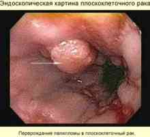 Tumorile maligne ale sistemului digestiv