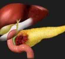 Cancerul de pancreas;