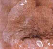 Cancerul de col uterin