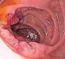 Cancer de intestin subțire