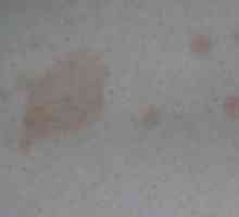 Pitiriazis versicolor (pitiriazis versicolor) pe piele
