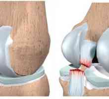 Diferența dintre ligamentelor genunchiului