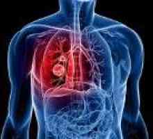Recidiva de cancer pulmonar