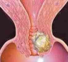 Reapariția cancerului de col uterin