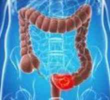 Recurenței cancerului de colon