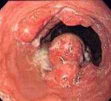 Recurența de cancer la stomac