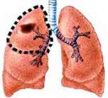 Sarcomul, pulmonar