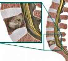 Coloanei vertebrale sarcomul
