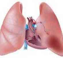 Insuficiență cardio-pulmonară