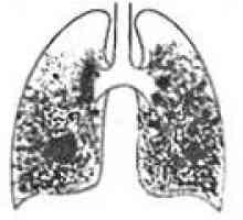 Tuberculosilicosis