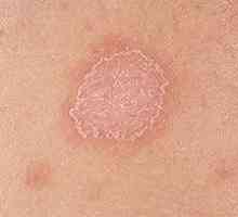 Simptomele și tratamentul lichenul roz