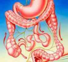 Sindromul intestinului iritabil (IBS)