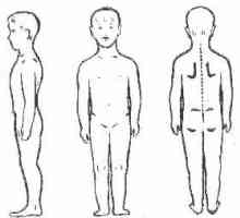 Scolioză a coloanei vertebrale, stoop, tulburare postura la copii și adulți
