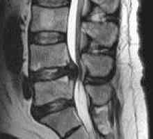 Abces epidural spinal