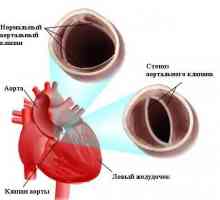 Dobândite stenoza aortica (stenoza aortica)