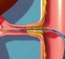 Stenoza arterei renale