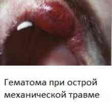 Stomatită (inflamație a cavității orale) cu fotografii