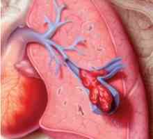 Embolie pulmonară (PE)