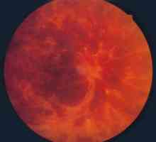 Tromboză venoasă retiniană