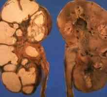 Tuberculoza a sistemului urogenital (nephrotuberculosis)