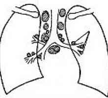 Tuberculoza ganglionilor limfatici intrathoracic