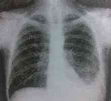 Pleurezie tuberculoasă