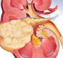 Carcinom cu celule renale Tubular