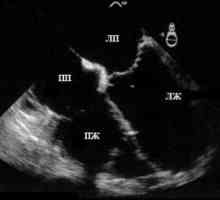 Cu ultrasunete a inimii (ecocardiografie)